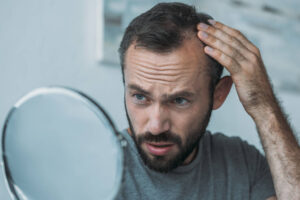 Worried man checking his receding hairline in a mirror