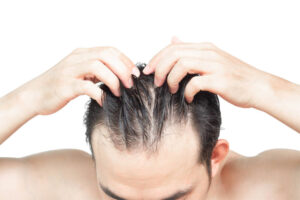 Closeup Young man serious hair loss problem